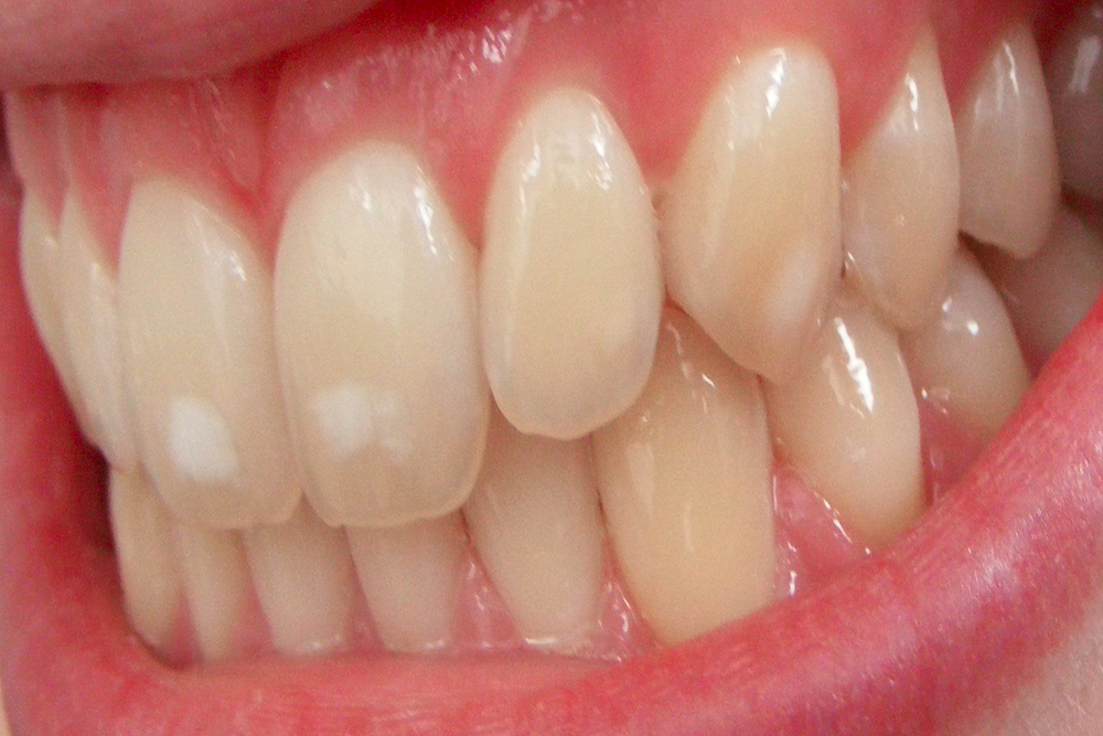 Fluoridation to the teeth can be seen by the by white patches formed