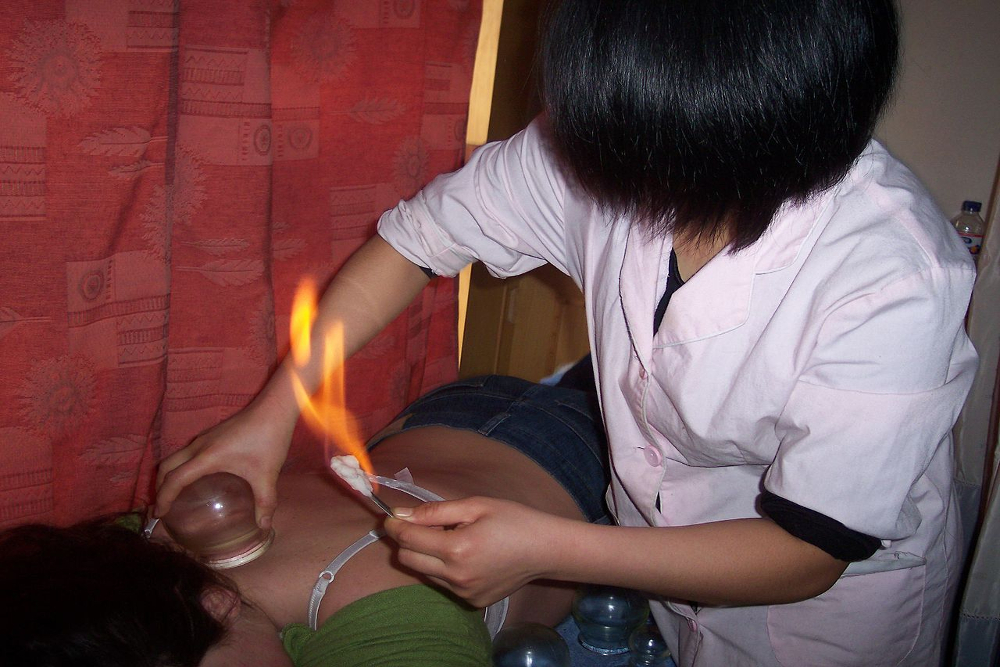 Cupping therapy with fire