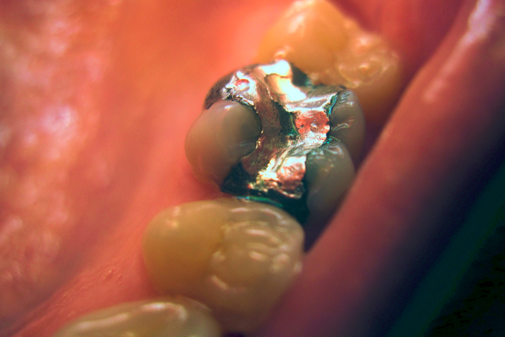 Amalgam filling on first molar